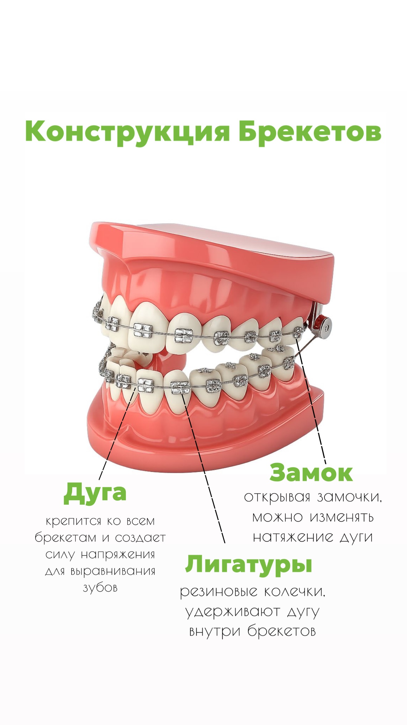 Брекеты - детали процедуры