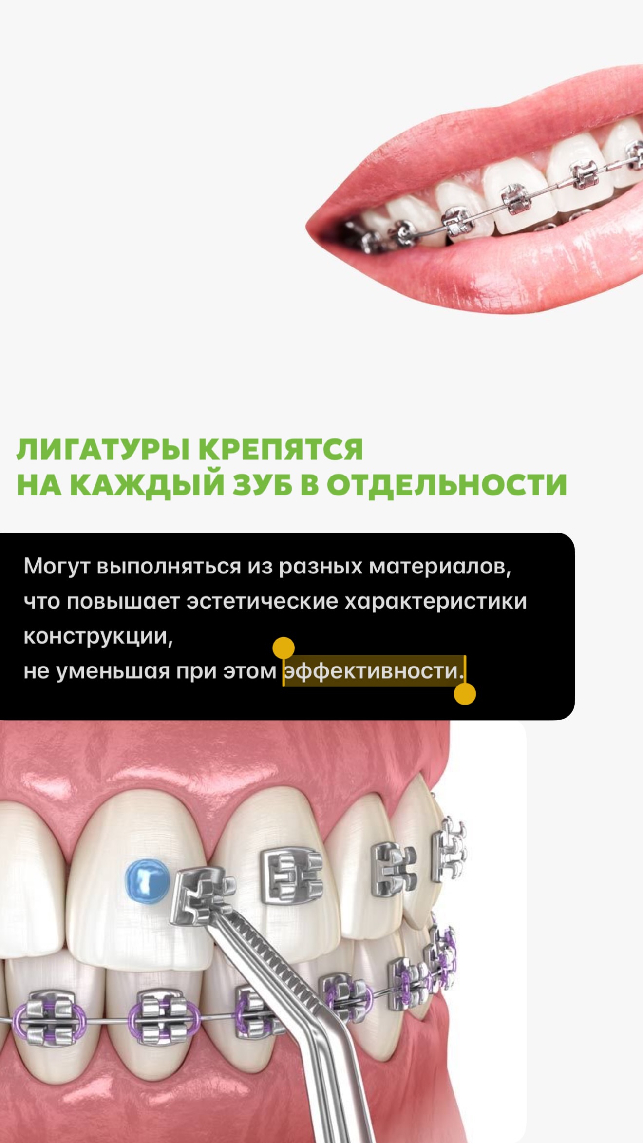 Конструкция брекетов