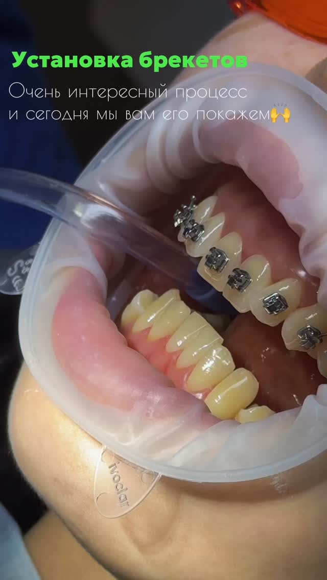 Установка брекетов в клинике