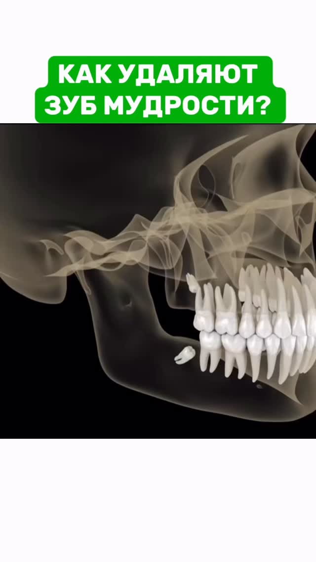Удаление зубов