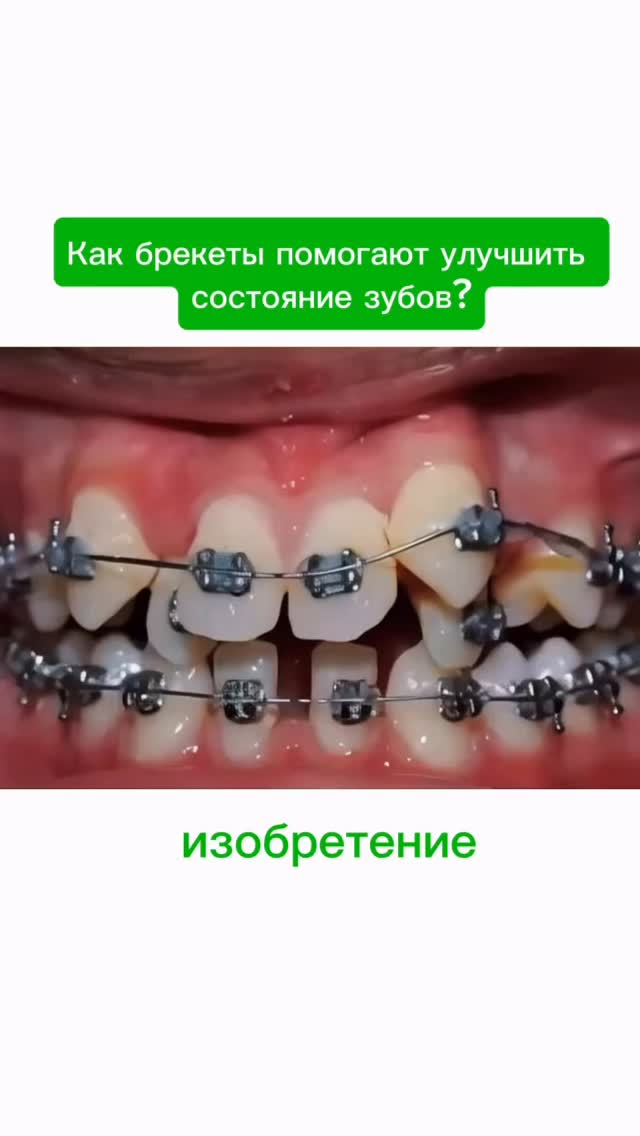 Результаты лечения брекетами